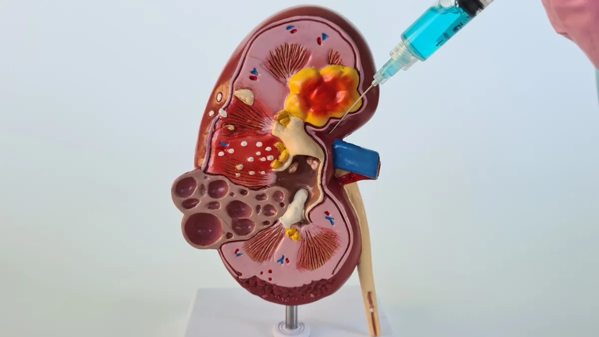 Glomerulonephritis