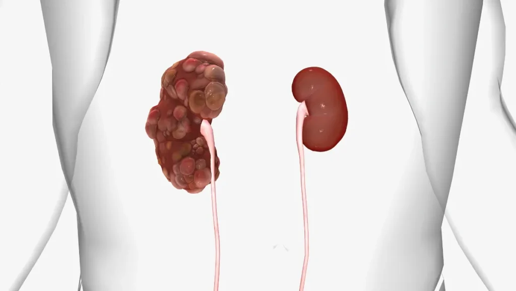 Polycystic Kidney Disease (PKD)