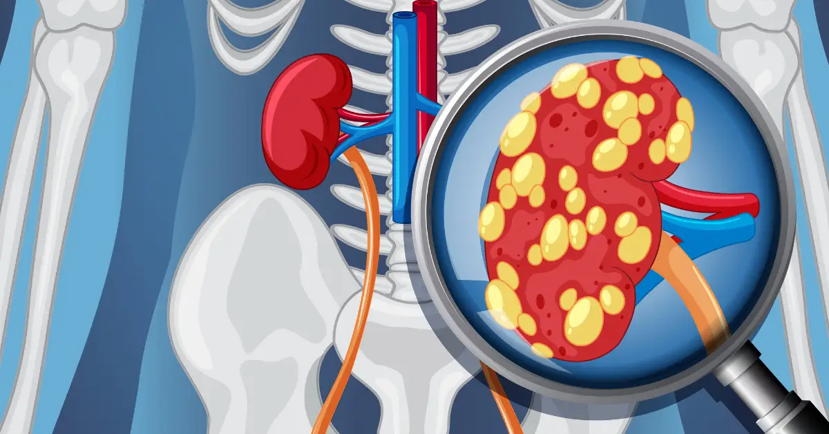 Glomerular Diseases