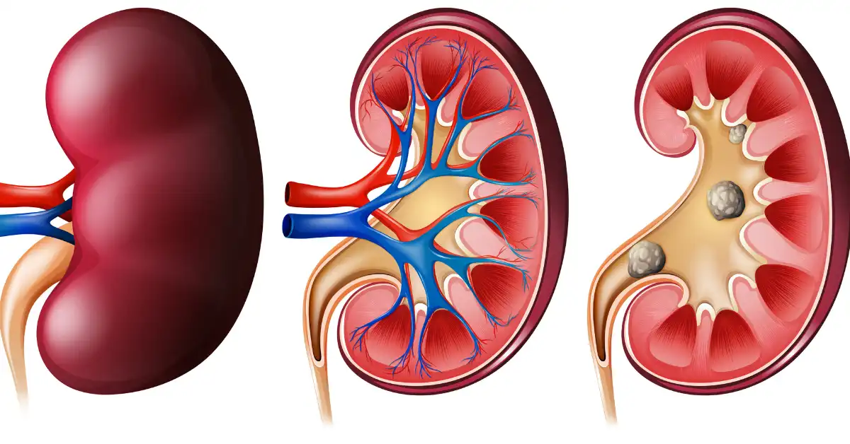 Kidney Failure