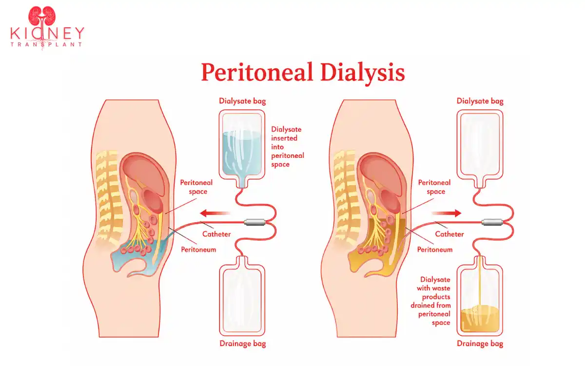 Peritoneal Dialysis