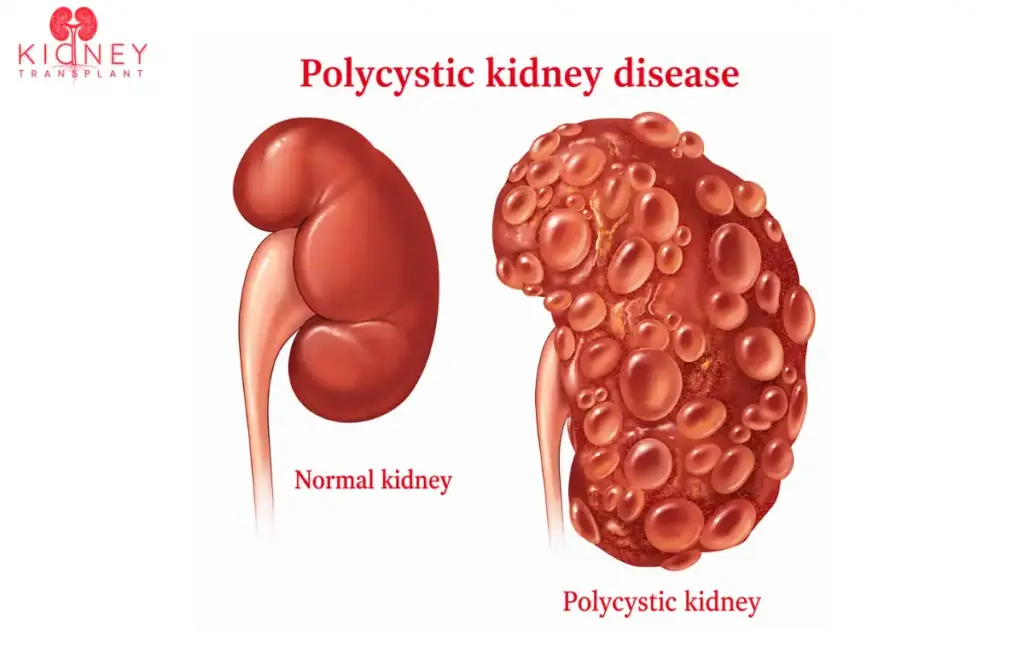 Polycystic Kidney Disease